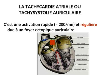 LA TACHYCARDIE ATRIALE OU
TACHYSYSTOLIE AURICULAIRE
C’est une activation rapide (≈ 200/mn) et régulière
due à un foyer ectopique auriculaire
 