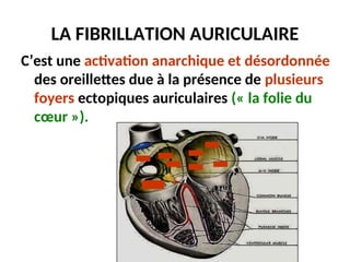 LA FIBRILLATION AURICULAIRE
C’est une activation anarchique et désordonnée
des oreillettes due à la présence de plusieurs
foyers ectopiques auriculaires (« la folie du
cœur »).
 