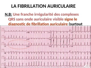 LA FIBRILLATION AURICULAIRE
N.B: Une franche irrégularité des complexes
QRS sans onde auriculaire visible signe le
diagnostic de fibrillation auriculaire (surtout
chez le sujet âgé).
 