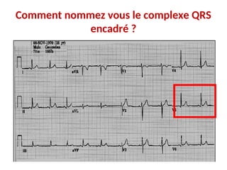 Comment nommez vous le complexe QRS
encadré ?
 