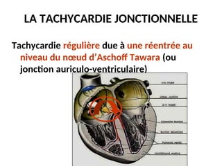 LA TACHYCARDIE JONCTIONNELLE
Tachycardie régulière due à une réentrée au
niveau du nœud d’Aschoff Tawara (ou
jonction auriculo-ventriculaire)
 