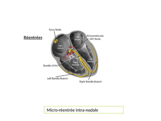 Réentrées :
Micro-réentrée intra-nodale
 
