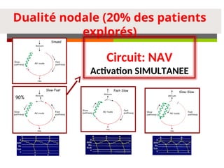Dualité nodale (20% des patients
explorés)
Sinusal
Slow-Fast Fast-Slow Slow-Slow
90%
Circuit: NAV
Activation SIMULTANEE
 