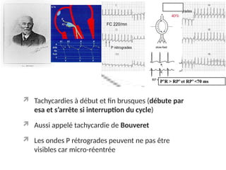  Tachycardies à début et fin brusques (débute par
esa et s’arrête si interruption du cycle)
 Aussi appelé tachycardie de Bouveret
 Les ondes P rétrogrades peuvent ne pas être
visibles car micro-réentrée
 