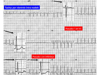 Pseudo r’ en V1
Pseudo s en inférieur
Tachyc par réentrée intra nodale
 