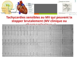 Tachycardies sensibles au MV qui peuvent la
stopper brutalement (MV clinique ou
« pharmacologique »)
 
