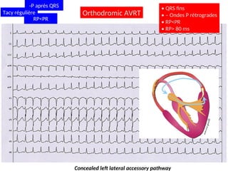 Concealed left lateral accessory pathway
Orthodromic AVRT
• QRS fins
• – Ondes P rétrogrades
• RP<PR
• RP> 80 ms
-P après QRS
RP<PR
Tacy régulière
 