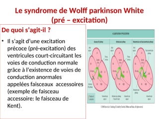 Le syndrome de Wolff parkinson White
(pré – excitation)
De quoi s’agit-il ?
• Il s’agit d’une excitation
précoce (pré-excitation) des
ventricules court-circuitant les
voies de conduction normale
grâce à l’existence de voies de
conduction anormales
appelées faisceaux accessoires
(exemple de faisceau
accessoire: le faisceau de
Kent).
 