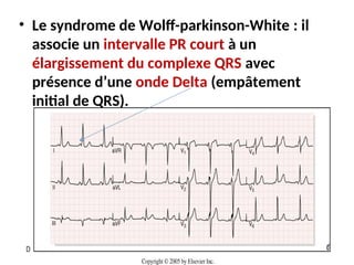 • Le syndrome de Wolff-parkinson-White : il
associe un intervalle PR court à un
élargissement du complexe QRS avec
présence d’une onde Delta (empâtement
initial de QRS).
 