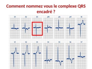 Comment nommez vous le complexe QRS
encadré ?
 