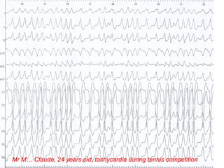 Mr M… Claude, 24 years old, tachycardia during tennis competition
 