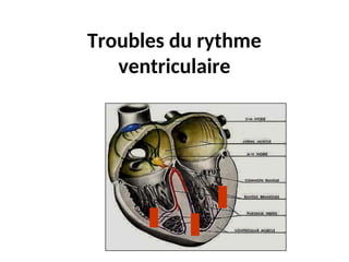 Troubles du rythme
ventriculaire
 