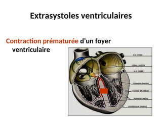 Extrasystoles ventriculaires
Contraction prématurée d’un foyer
ventriculaire
 