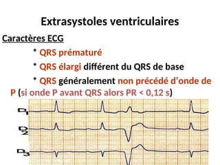 Extrasystoles ventriculaires
Caractères ECG
* QRS prématuré
* QRS élargi différent du QRS de base
* QRS généralement non précédé d’onde de
P (si onde P avant QRS alors PR < 0,12 s)
 