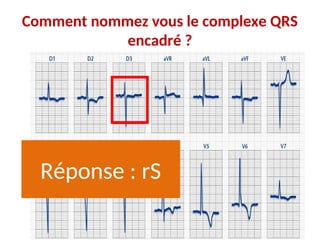 Comment nommez vous le complexe QRS
encadré ?
Réponse : rS
 