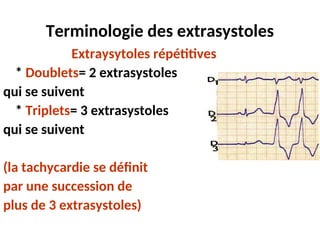 Terminologie des extrasystoles
Extraysytoles répétitives
* Doublets= 2 extrasystoles
qui se suivent
* Triplets= 3 extrasystoles
qui se suivent
(la tachycardie se définit
par une succession de
plus de 3 extrasystoles)
 