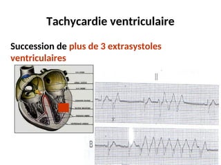 Tachycardie ventriculaire
Succession de plus de 3 extrasystoles
ventriculaires
 