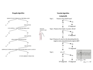 Brugada and Vereckei algorithms to differentiate VT from SVT with aberration.
Key measurement elements are shown on the right of each algorithm.
For the Brugada algorithm, the last step involves morphological criteria.
Differential diagnosis of supraventricular tachycardias, Author(s): Haran Burri, From: ESC CardioMed
 