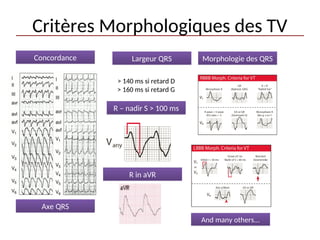 > 140 ms si retard D
> 160 ms si retard G
Concordance Largeur QRS Morphologie des QRS
Axe QRS
R – nadir S > 100 ms
R in aVR
And many others...
Critères Morphologiques des TV
 