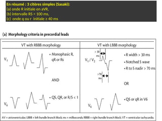 En résumé : 3 citères simples (Sasaki):
(a) onde R initiale en aVR,
(b) intervalle RS > 100 ms,
(c) onde q ou r initiale ≥ 40 ms
 
