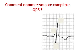 Comment nommez vous ce complexe
QRS ?
 
