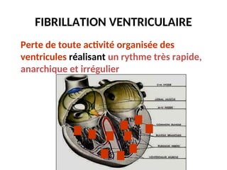 FIBRILLATION VENTRICULAIRE
Perte de toute activité organisée des
ventricules réalisant un rythme très rapide,
anarchique et irrégulier
 