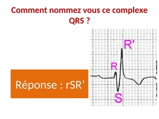 Comment nommez vous ce complexe
QRS ?
Réponse : rSR’
 