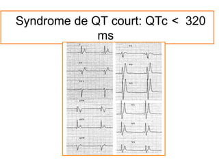 Syndrome de QT court: QTc < 320
ms
 