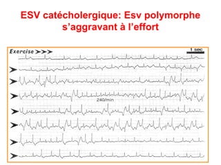 ESV catécholergique: Esv polymorphe
s’aggravant à l’effort
 