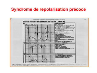 Syndrome de repolarisation précoce
 