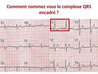 Comment nommez vous le complexe QRS
encadré ?
 