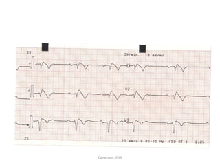 Syndrome de Brugada; Jeune Sénégalais de 27 ans:
Aspect de Bloc de branche droit et d’un « sus-décalage
de ST » en V1, V2, V3
Cameroun 2014
 