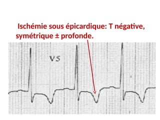 Ischémie sous épicardique: T négative,
symétrique ± profonde.
 