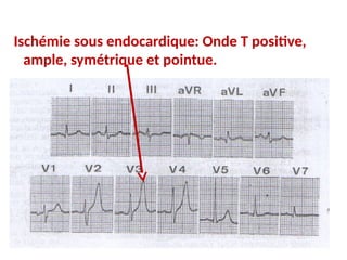 Ischémie sous endocardique: Onde T positive,
ample, symétrique et pointue.
 