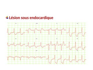 Lésion sous endocardique
 