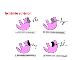 Ischémie et lésion
 