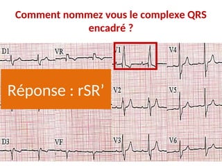 Comment nommez vous le complexe QRS
encadré ?
Réponse : rSR’
 