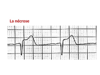 La nécrose
 