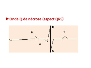 ►Onde Q de nécrose (aspect QRS)
 