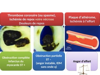 Thrombose coronaire (ou spasme),
Ischémie de repos voire nécrose
Douleurs de repos
Obstruction complète
Infarctus du
myocarde ST +
Obstruction partielle
ST –
(angor instable, IDM
sans onde q)
Angor d’effort
Plaque d’athérome,
Ischémie à l’effort
 
