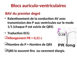 Blocs auriculo-ventriculaires
BAV du premier degré
• Ralentissement de la conduction AV avec
transmission des P aux ventricules sur le mode
1/1 (chaque P est suivie de QRS)
• Traduction ECG:
Allongement PR > 0,21 s
Nombre de P = Nombre de QRS
QRS le souvent fins ou rarement élargis.
 