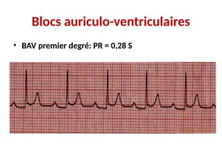 Blocs auriculo-ventriculaires
• BAV premier degré: PR = 0,28 S
 