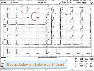 BAV 1
Bloc auriculo-ventriculaire du 1er
degré
 