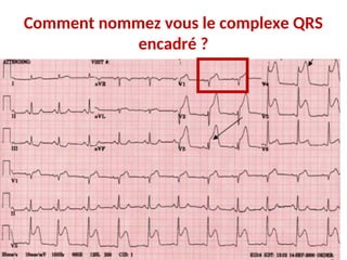 Comment nommez vous le complexe QRS
encadré ?
 