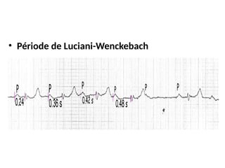 • Période de Luciani-Wenckebach
 