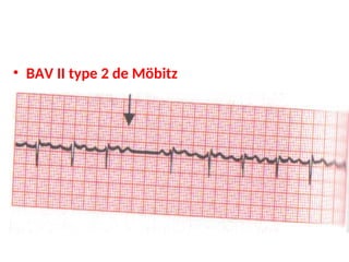 • BAV II type 2 de Möbitz
 