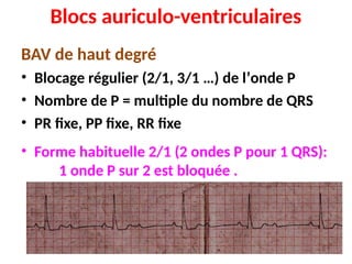 Blocs auriculo-ventriculaires
BAV de haut degré
• Blocage régulier (2/1, 3/1 …) de l’onde P
• Nombre de P = multiple du nombre de QRS
• PR fixe, PP fixe, RR fixe
• Forme habituelle 2/1 (2 ondes P pour 1 QRS):
1 onde P sur 2 est bloquée .
 