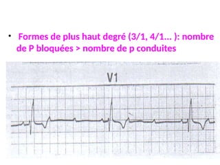 • Formes de plus haut degré (3/1, 4/1... ): nombre
de P bloquées > nombre de p conduites
 