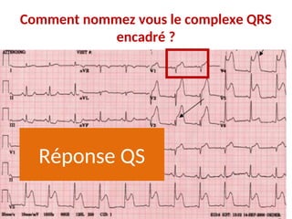 Comment nommez vous le complexe QRS
encadré ?
Réponse QS
 