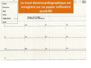 Nom
Prénom
Age
Sexe
Indication
date
Le tracé électrocardiographique est
enregistré sur un papier millimétré
quadrillé
 